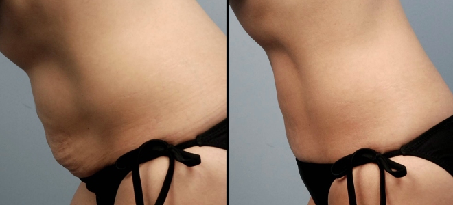 ultrazvočna liposukcija trebuha pred in po slikah