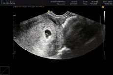 ultrazvuk v 5. týdnu těhotenství