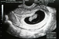 ultrazvuk 5 týdnů