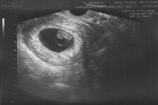 ultrazvok v sedmem tednu nosečnosti