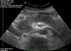 ultrazvučni transkript pankreasa