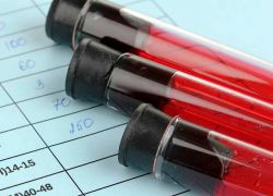 krvna analiza sečne kisline je normalna pri ženskah
