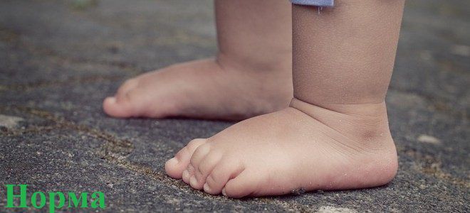 Признаки вальгусной стопы у детей норма два