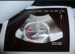 ventrikulomegalija stranskih prekatov fetusa