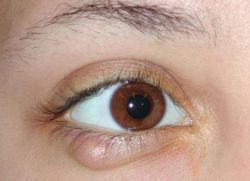 usuń gruczolak z gałki ocznej