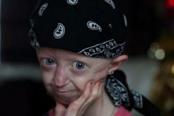Dospělý progeria