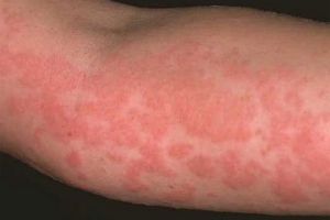 Как изглежда обривът с алергии?