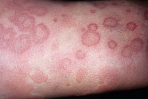 jak vypadá alergie na kůži