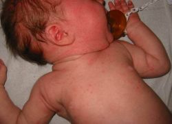 pimples u novorođenčadi
