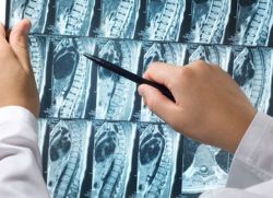 MRI odcinka piersiowego kręgosłupa
