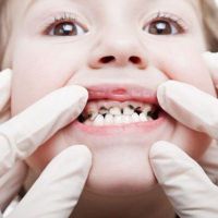 proč děti mají černé zuby