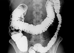 рентгеново черво с барий, което показва